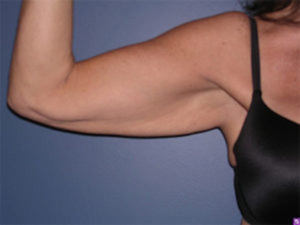 Arm Lift Before & After Gallery - Patient 4595157 - Image 1
