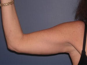Brachioplasty