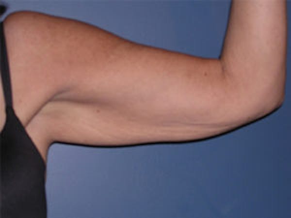 Arm Lift Before & After Gallery - Patient 4595157 - Image 3