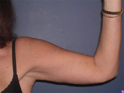 Arm Lift Before & After Gallery - Patient 4595157 - Image 4