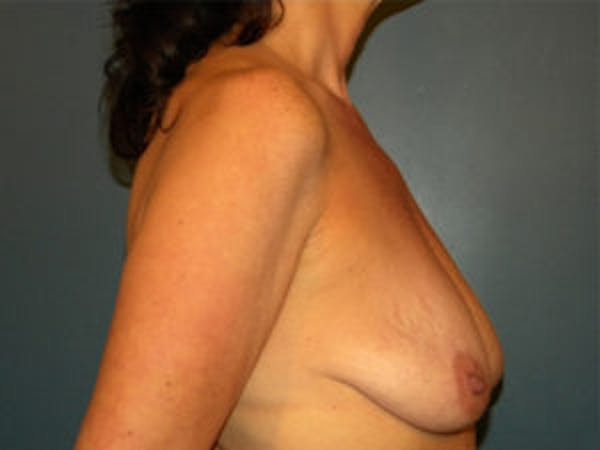 Mastopexy Before & After Gallery - Patient 4709860 - Image 3