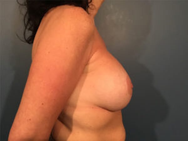 Mastopexy Before & After Gallery - Patient 4709860 - Image 4
