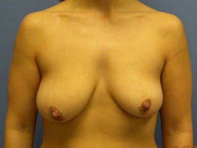 Mastopexy Before & After Gallery - Patient 4709861 - Image 1