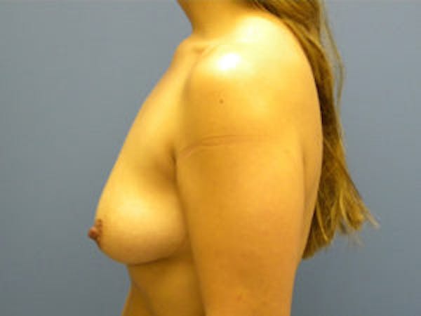 Mastopexy Before & After Gallery - Patient 4709861 - Image 3