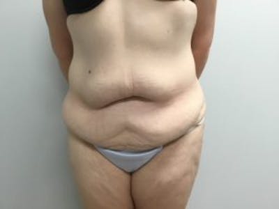 Tummy Tuck (Abdominoplasty) Before & After Gallery - Patient 4710438 - Image 1