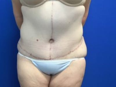 Tummy Tuck (Abdominoplasty) Before & After Gallery - Patient 4710438 - Image 2