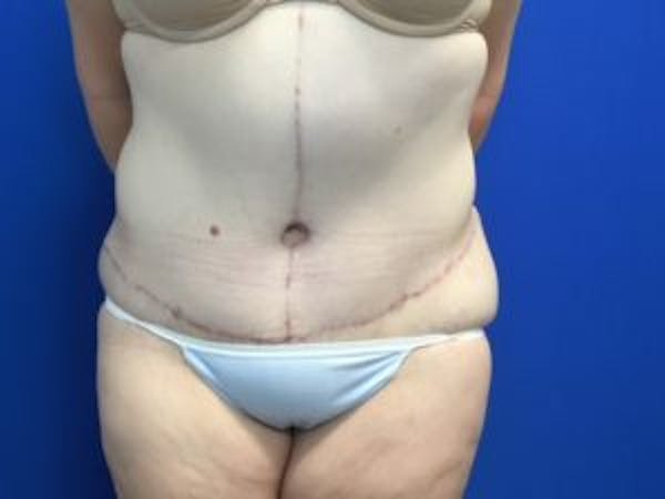 Tummy Tuck (Abdominoplasty) Before & After Gallery - Patient 4710438 - Image 2