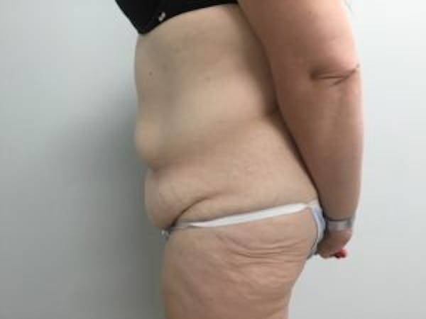Tummy Tuck (Abdominoplasty) Before & After Gallery - Patient 4710438 - Image 3