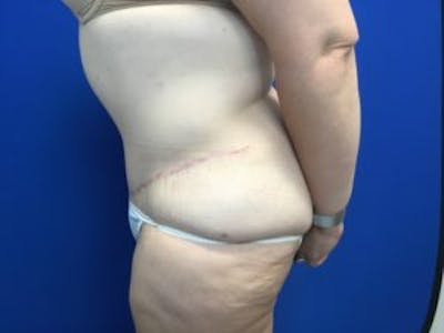 Tummy Tuck (Abdominoplasty) Before & After Gallery - Patient 4710438 - Image 4