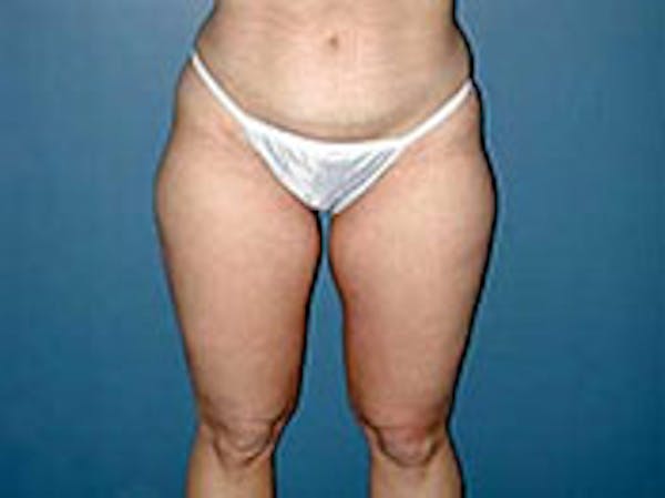Thigh Lift Before & After Gallery - Patient 4595175 - Image 1