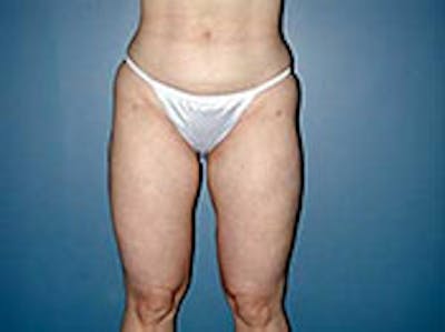 Thigh Lift Before & After Gallery - Patient 4595175 - Image 2