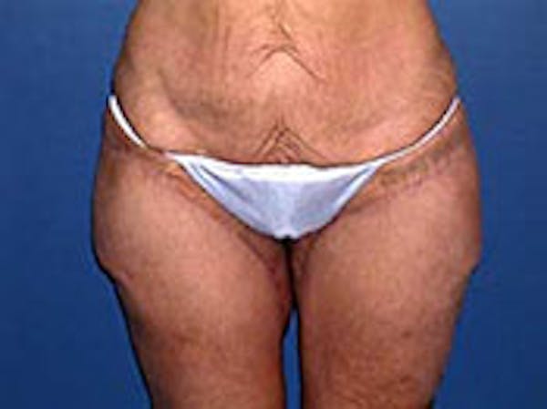 Thigh Lift Before & After Gallery - Patient 4595176 - Image 2