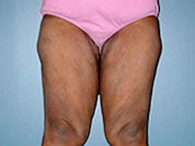 Thigh Lift Before & After Gallery - Patient 4595178 - Image 1
