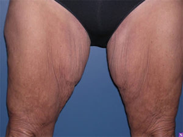 Thigh Lift Before & After Gallery - Patient 4595179 - Image 1