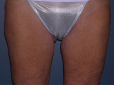 Thigh Lift Before & After Gallery - Patient 4595179 - Image 2