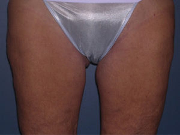 Thigh Lift Before & After Gallery - Patient 4595179 - Image 2