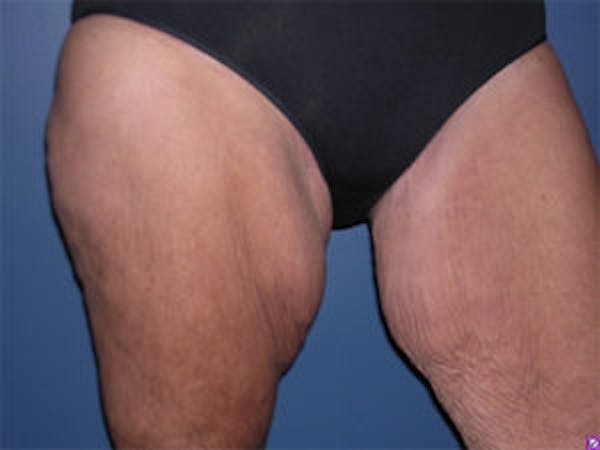 Thigh Lift Before & After Gallery - Patient 4595179 - Image 3