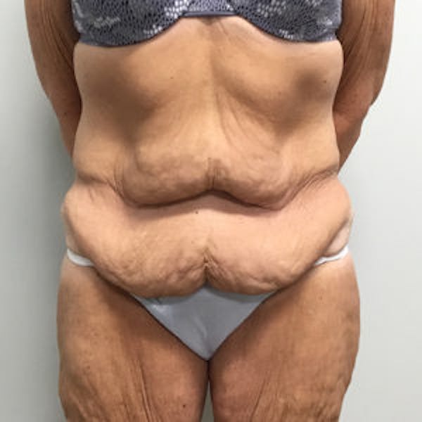 Post Bariatric Before & After Gallery - Patient 4595180 - Image 1