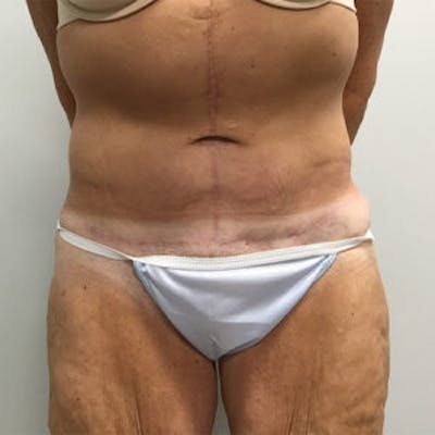 Tummy Tuck (Abdominoplasty) Before & After Gallery - Patient 4710439 - Image 2