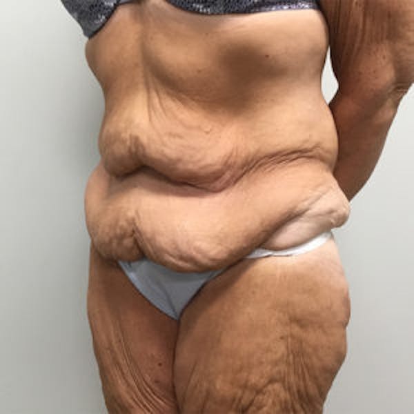 Post Bariatric Before & After Gallery - Patient 4595180 - Image 3