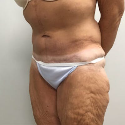 Post Bariatric Before & After Gallery - Patient 4595180 - Image 4