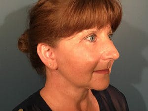 Facelift in Richmond Before & After Photos