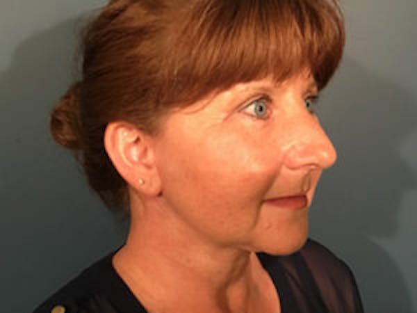 Face Lift Before & After Gallery - Patient 4595193 - Image 4