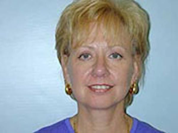 Face Lift Before & After Gallery - Patient 4595194 - Image 4