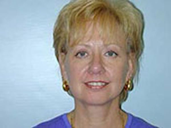 Face Lift Before & After Gallery - Patient 4595194 - Image 2