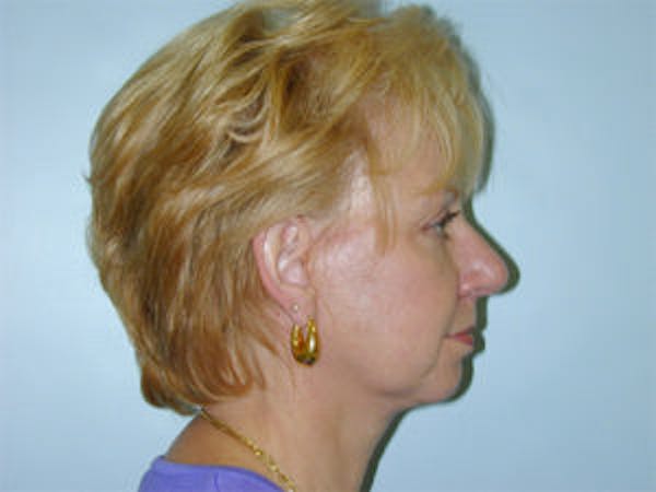 Face Lift Before & After Gallery - Patient 4595194 - Image 4