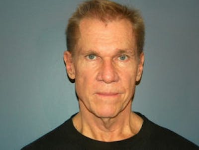 Face Lift Before & After Gallery - Patient 4595197 - Image 1