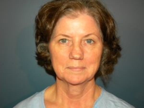 Face Lift Before & After Gallery - Patient 4595200 - Image 3