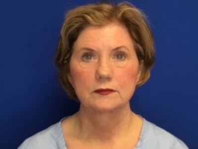 Face Lift Before & After Gallery - Patient 4595200 - Image 2