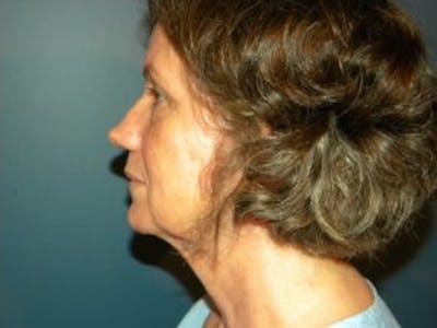 Face Lift Before & After Gallery - Patient 4595200 - Image 1