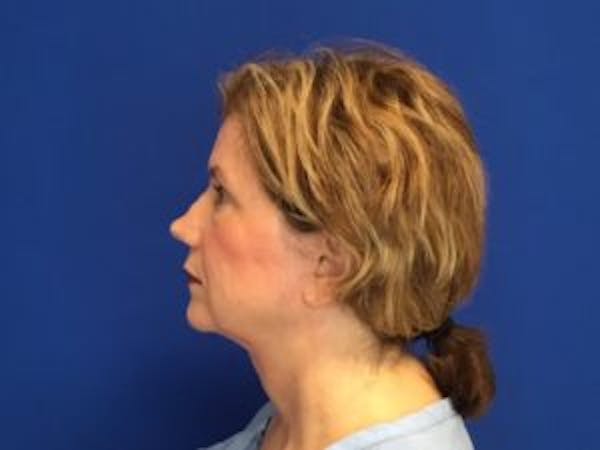 Face Lift Before & After Gallery - Patient 4595200 - Image 4