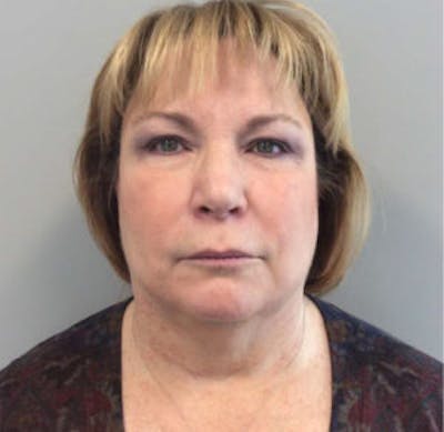 Face Lift Before & After Gallery - Patient 4595208 - Image 1