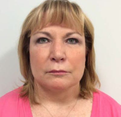 Face Lift Before & After Gallery - Patient 4595208 - Image 4