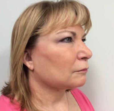 Face Lift Before & After Gallery - Patient 4595208 - Image 6