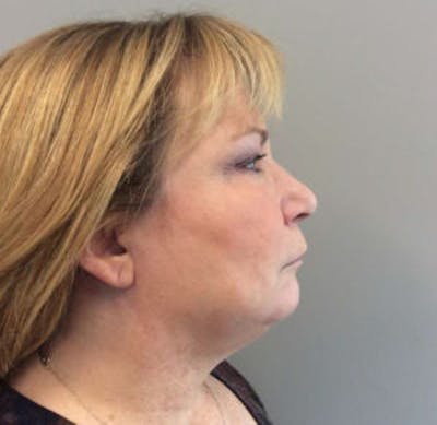 Face Lift Before & After Gallery - Patient 4595208 - Image 1