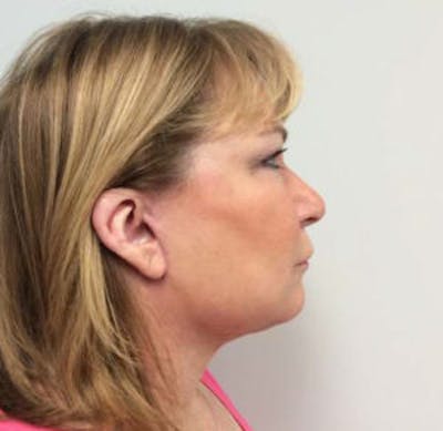 Face Lift Before & After Gallery - Patient 4595208 - Image 2