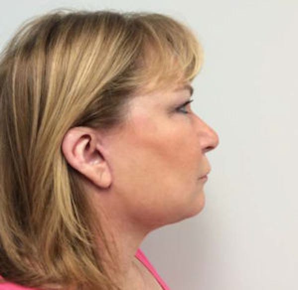 Face Lift Before & After Gallery - Patient 4595208 - Image 2