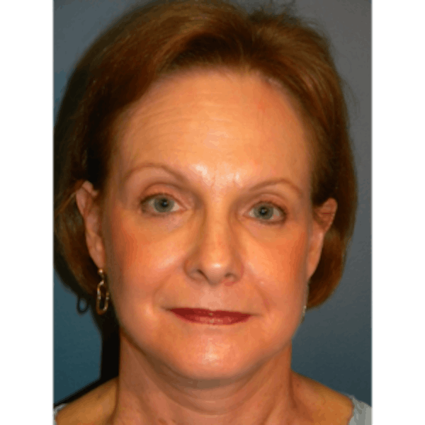 Face Lift Before & After Gallery - Patient 4595211 - Image 4