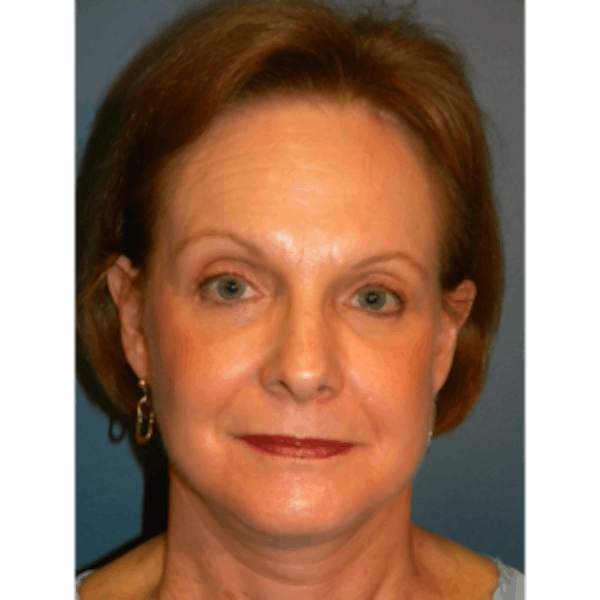 Face Lift Before & After Gallery - Patient 4595211 - Image 2