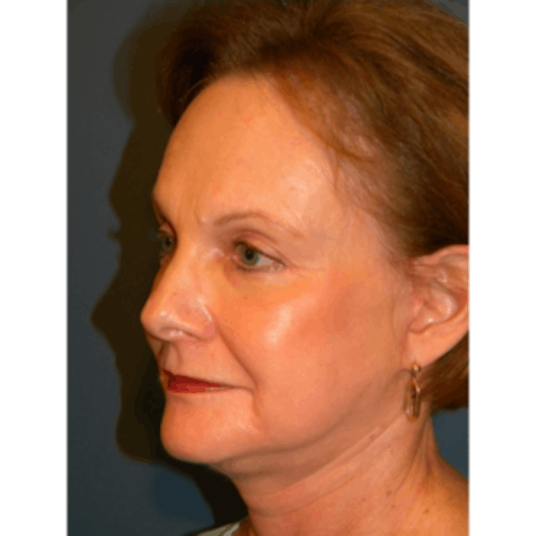 Face Lift Before & After Gallery - Patient 4595211 - Image 4