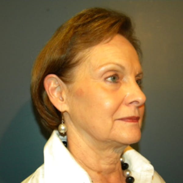 Face Lift Before & After Gallery - Patient 4595211 - Image 7