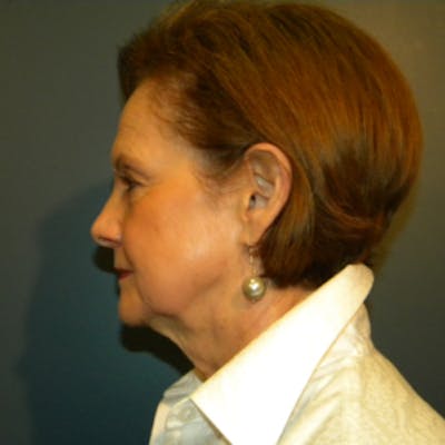 Face Lift Before & After Gallery - Patient 4595211 - Image 1