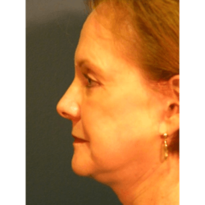 Face Lift Before & After Gallery - Patient 4595211 - Image 2