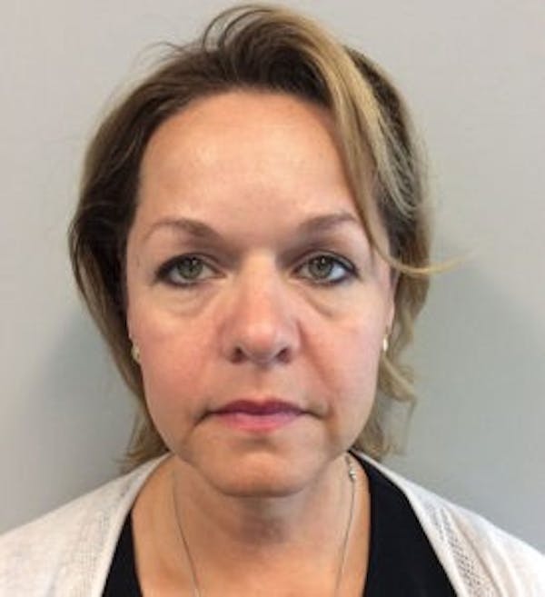 Face Lift Before & After Gallery - Patient 4595213 - Image 3