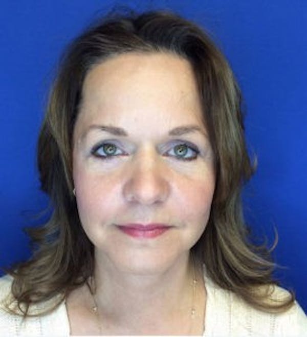 Face Lift Before & After Gallery - Patient 4595213 - Image 4