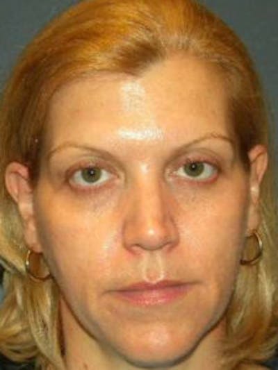 Face Lift Before & After Gallery - Patient 4595215 - Image 1
